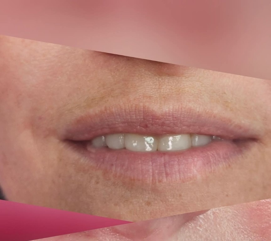 Before permanent lip color — natural lips before the service